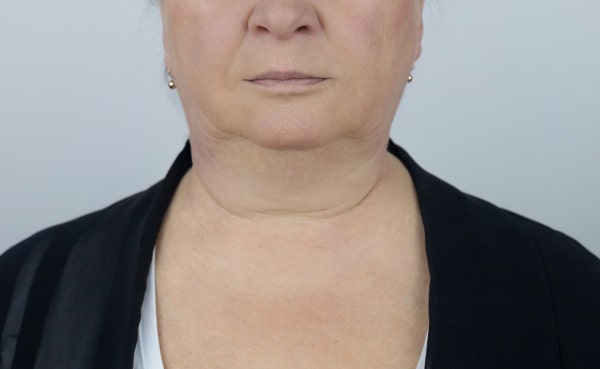 Drooping Mouth Corners after