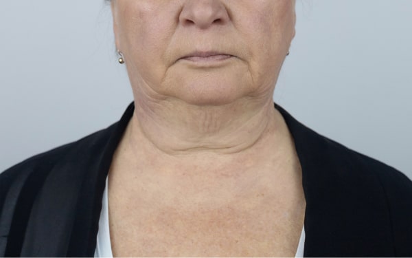 Drooping Mouth Corners before