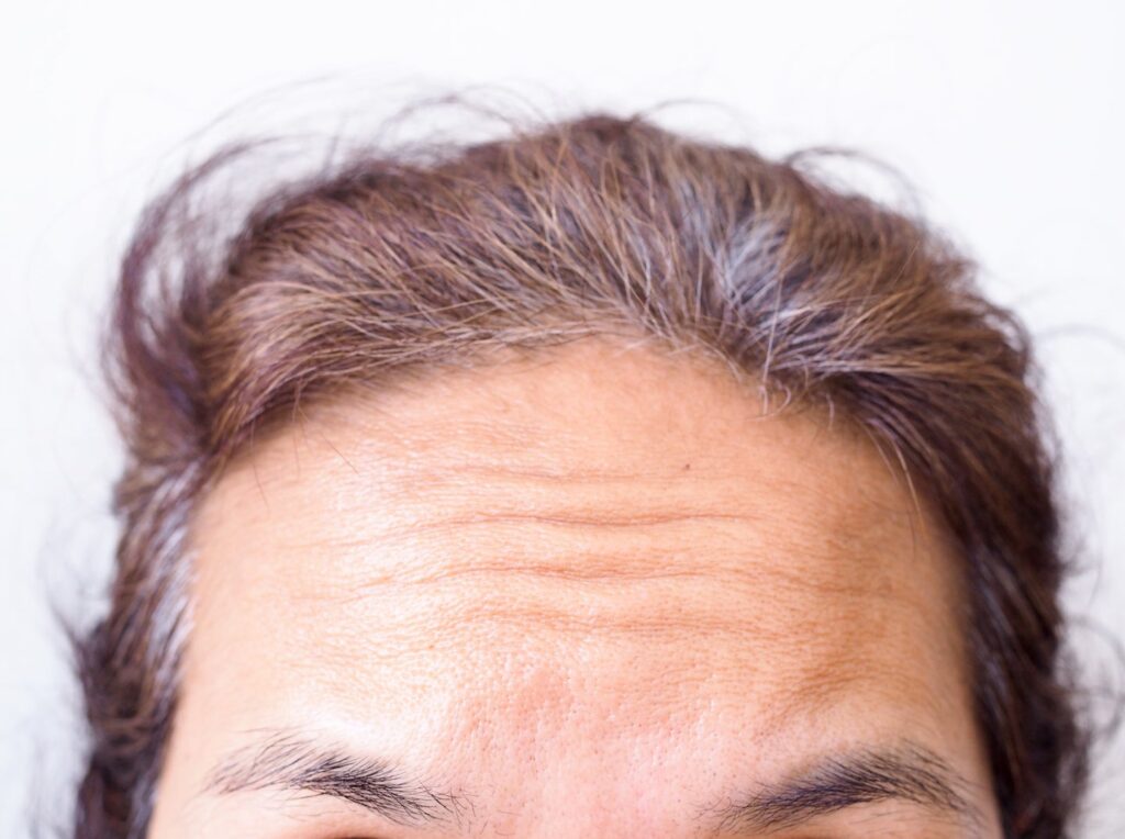 Treating Horizontal Forehead Lines