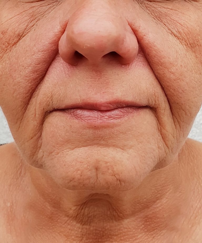 Nasolabial folds
