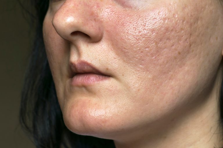 Acne scarring