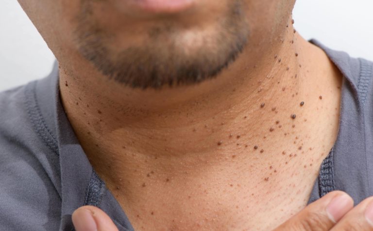 Skin tags