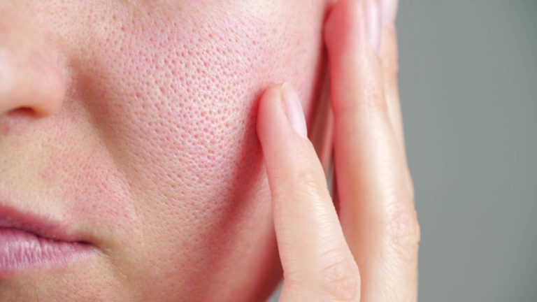 Enlarged pores
