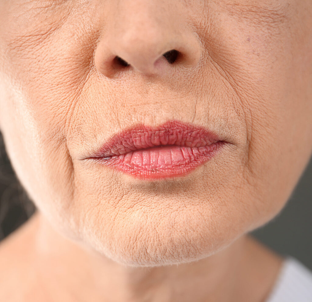 What Is a Marionette Line Treatment?