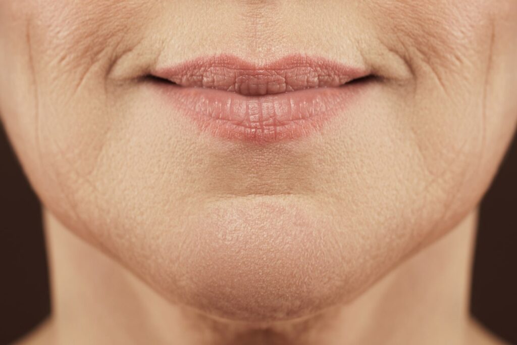 What Are the Causes of Lip Lines?