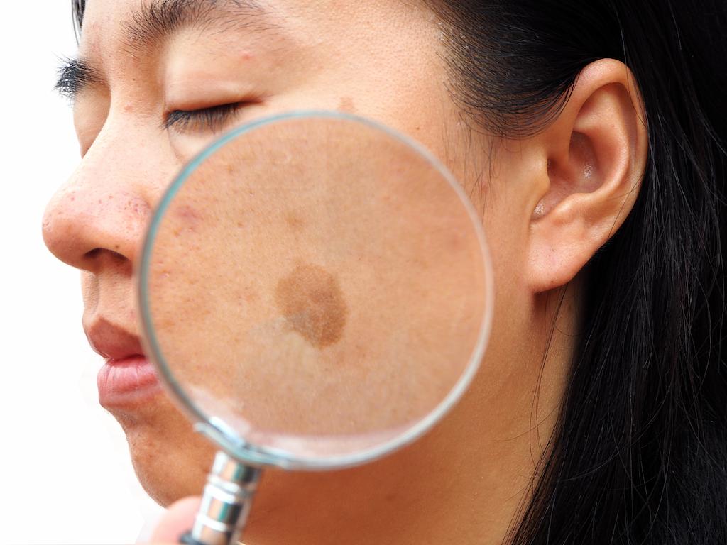 What Are Melasma Symptoms?