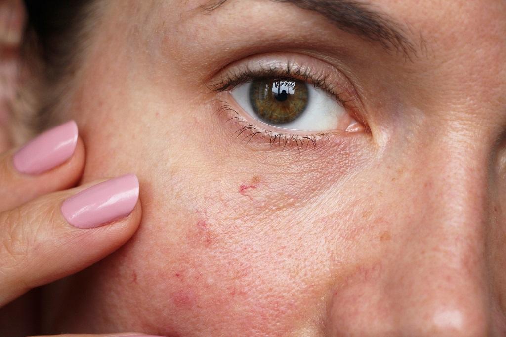 What Causes Telangiectasia on the Face?