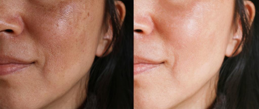 melasma laser treatment near me